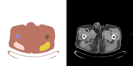 An example of a typical CT image generated from mask condition, showing how this pair of image and mask are well aligne
