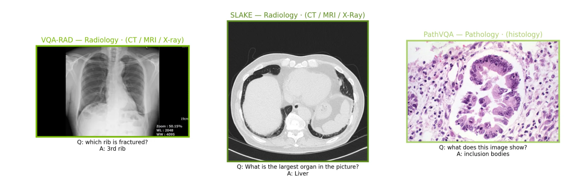 Three example medical images, one from each dataset: VQA-RAD with a chest X-ray captioning "Q: which rib is fractured? A: 3rd rib", SLAKE with a chest CT captioning "Q: What is the largest organ in the picture? A: Liver", and PathVQA with a microscopy slide of stained tissue captioning "Q: what does this image show? A: inclusion bodies."