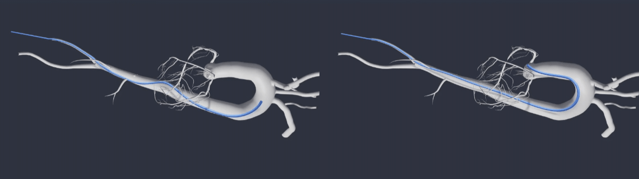 Two catheter paths through simulation vasculature. 