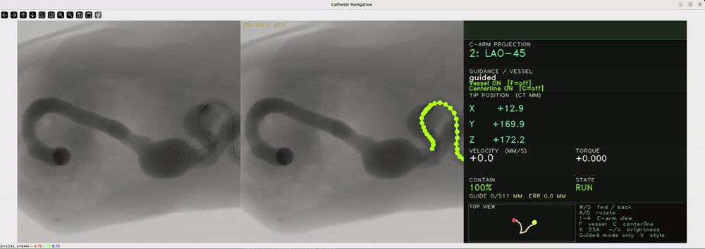 Simulated fluoroscopy with catheter navigation guidance.