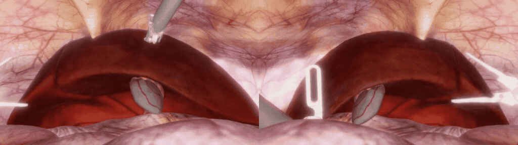 A Gif of a simulated robotic cholecystectomy.