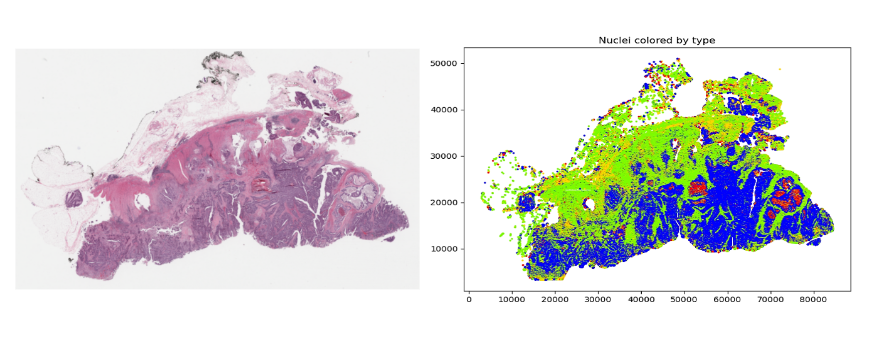Two images showing how MONAI’s HoVerNet model is able to segment and classify a histology image.