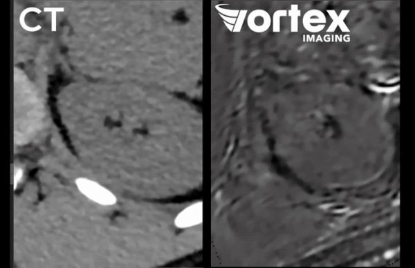 A GIF of a side-by-side comparison of Vortex vs. CT imaging of human kidney slices presenting detailed anatomical cross-sections.